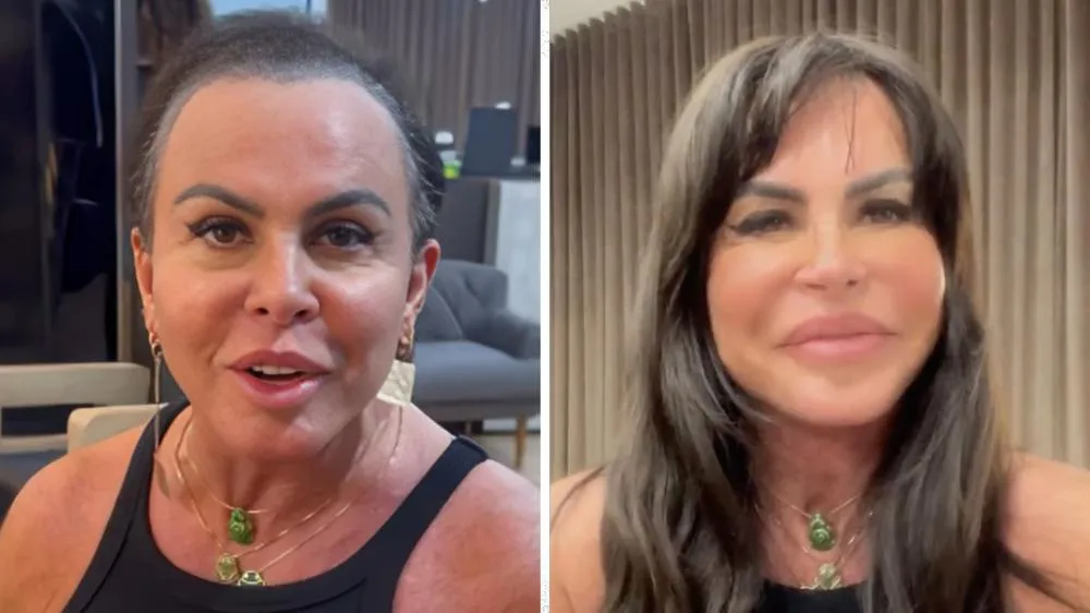 Gretchen comemora resultado de tratamento de alopecia: “Meu cabelo está voltando”