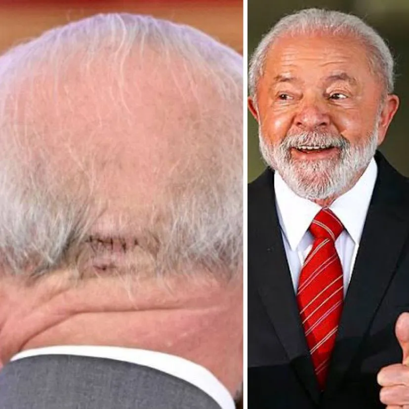 Lula é internado às pressas na UTI após sintomas de hemorragia cerebral