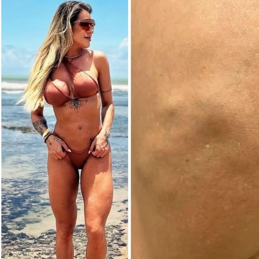 Quem é a influenciadora que ficou com a perna deformada após procedimento estético ‘modinha’ e culpou famosas pela influência da ‘busca pelo corpo perfeito’