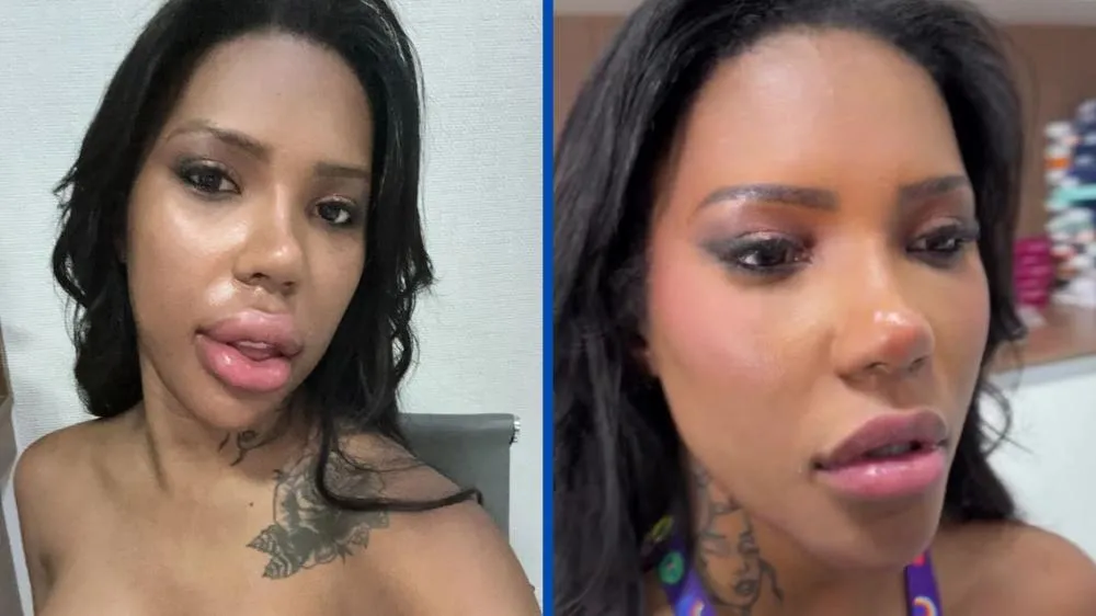 Carol Lekker assusta ao surgir com lábios inchados após procedimentos e explica: “Efeito da remoção”