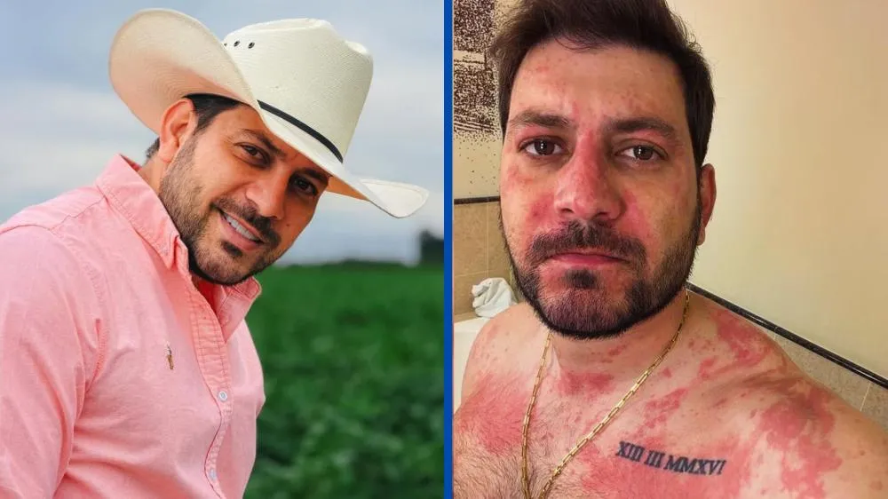 Ex-BBB Caio Afiune vai parar no hospital após crise alérgica e atualiza fãs: “Situação delicada”