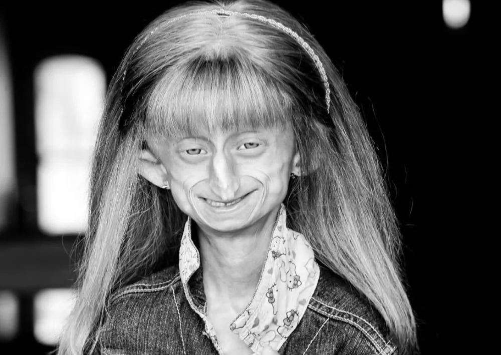 Beandri Booysen, influenciadora com doença rara, morre aos 19 anos