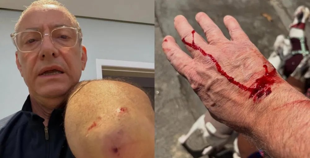 Jornalista da Globo é atacado por pitbull em São Paulo e desabafa após levar pontos: “O preço da irresponsabilidade”
