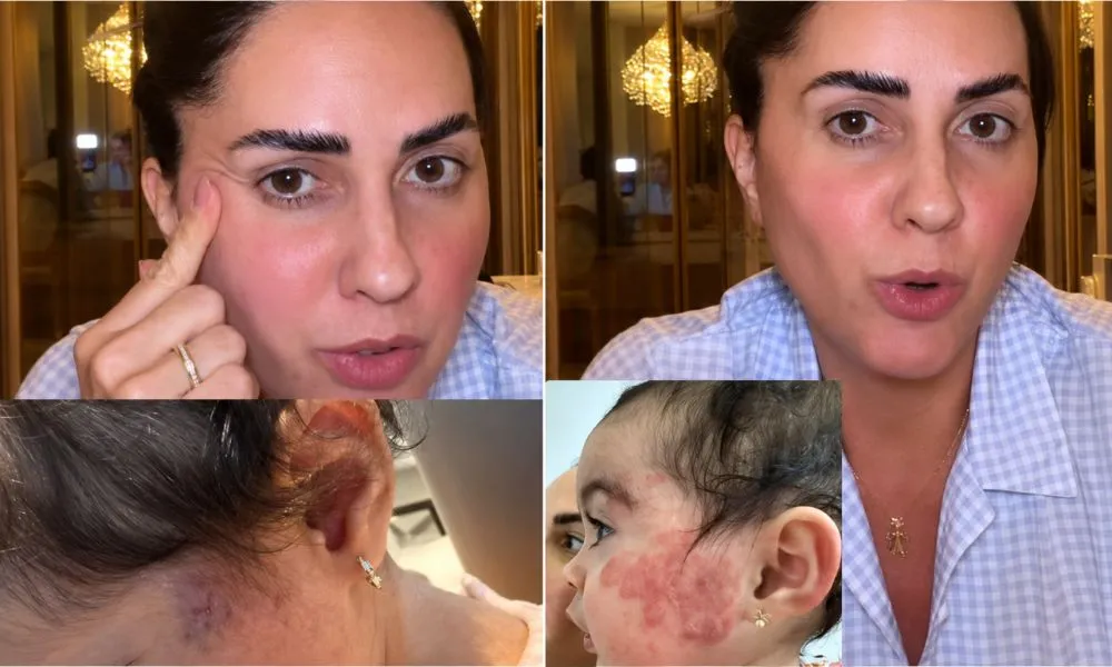 Graciele Lacerda revela que filha passou por procedimento no rosto: “Fiquei muito apreensiva”