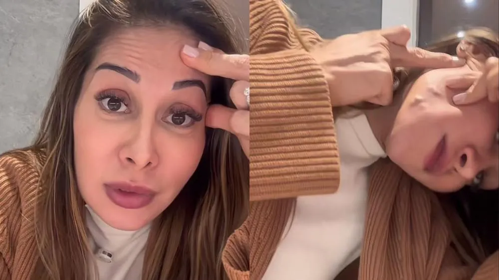 Maíra Cardi expõe complicações no rosto após procedimento estético e faz alerta sobre uso de PMMA