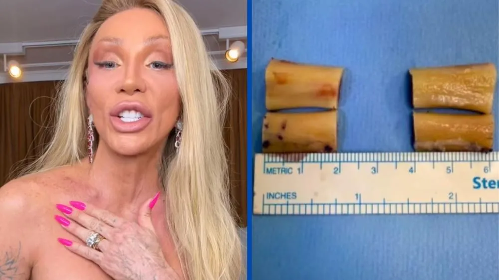 Maya Massafera mostra ossos retirados para diminuir as costas: “Agora eu tenho um corpo feminino”