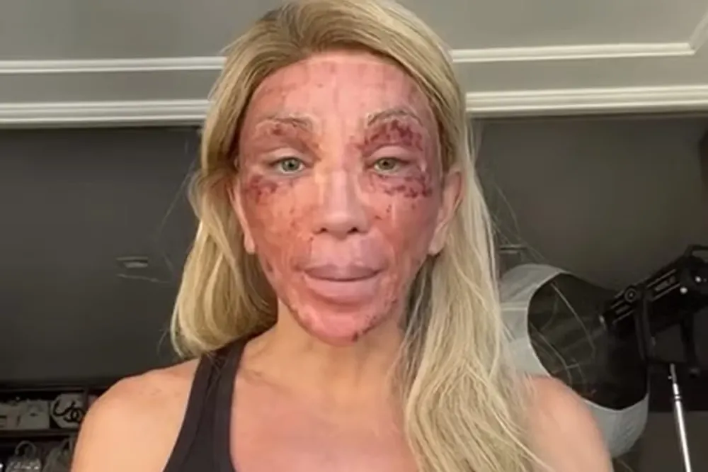 Maya Massafera assusta seguidores ao surgir com rosto machucado em meio a tratamento estético