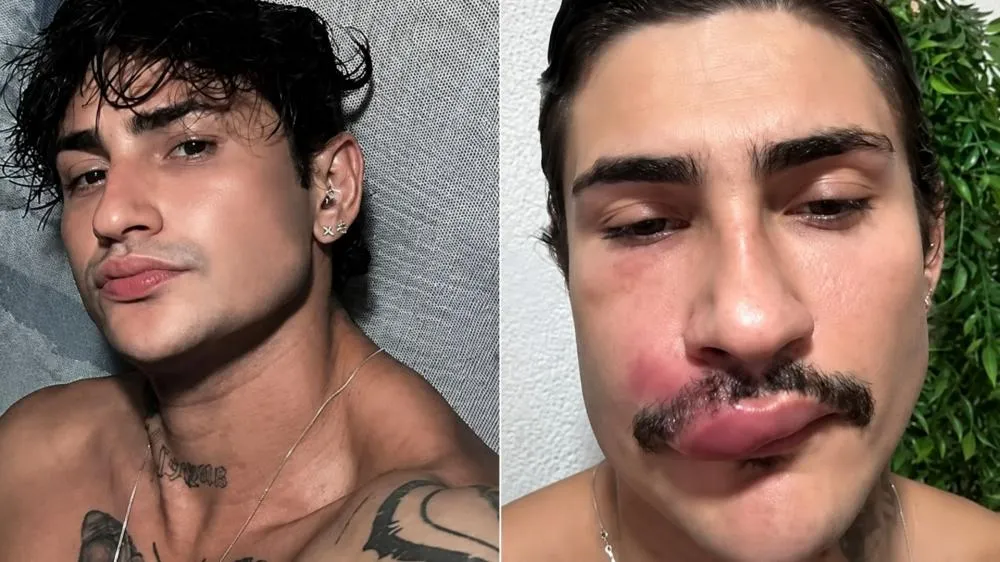 Influenciador é hospitalizado após espremer espinha no “triângulo da morte”; entenda o caso