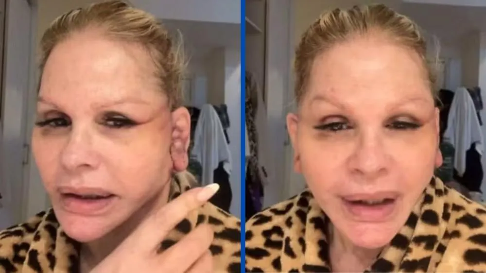 Monique Evans surge após cirurgia no rosto e revela problema inesperado: “Parece um bicho do mar”