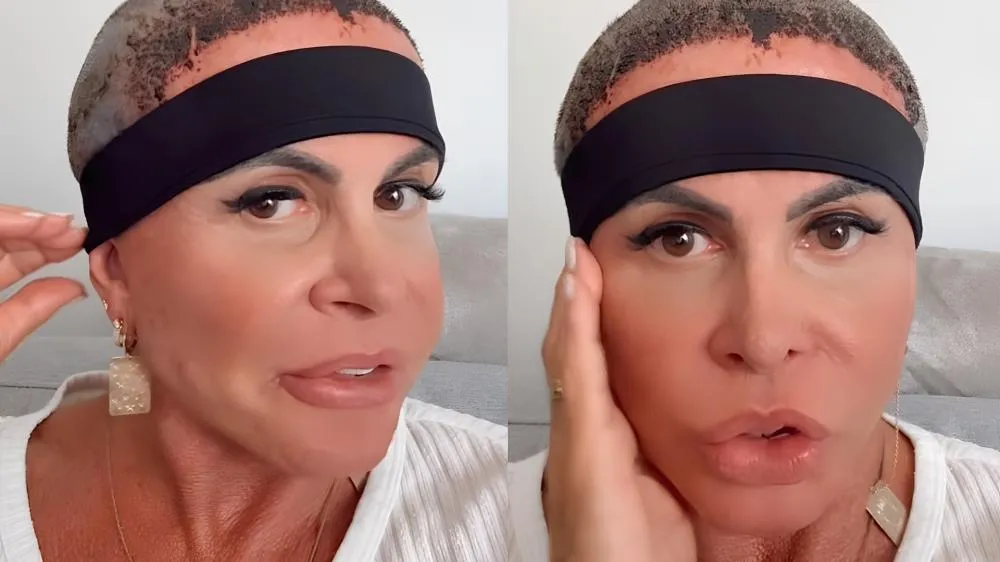 Gretchen atualiza fãs sobre sua recuperação após realizar transplante capilar
