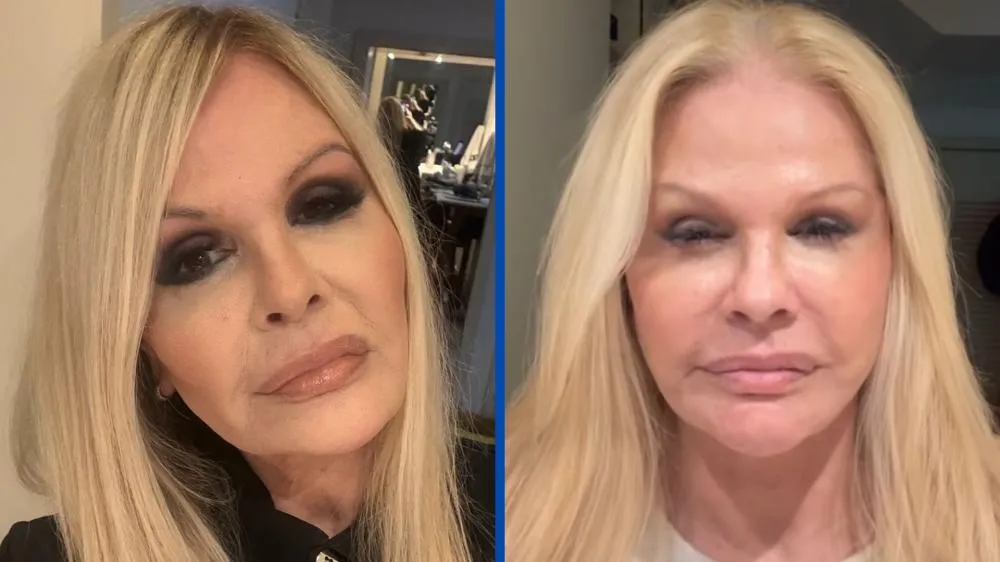 Antes e depois: Monique Evans comemora transformação após cirurgia facial