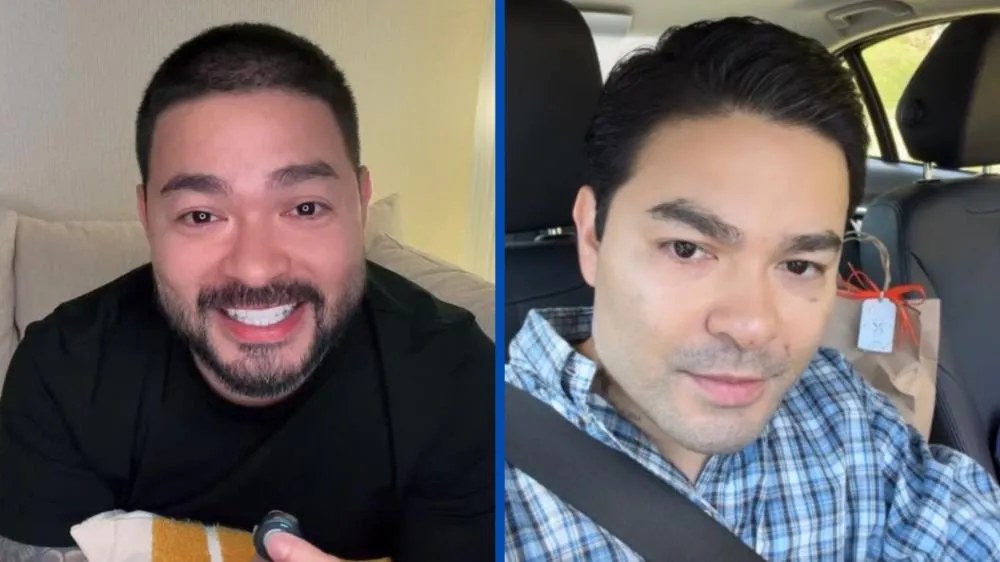 Yudi Tamashiro mostra resultado de harmonização facial e se surpreende com resultado