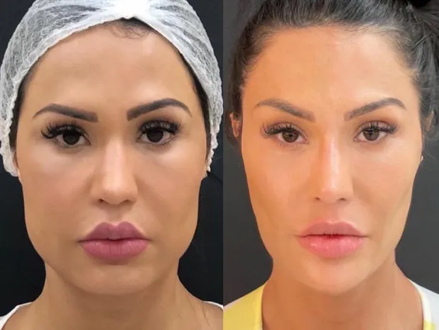 Tendência de beleza de 2025 está influenciando a “desarmonização facial”; influenciadores entram na onda