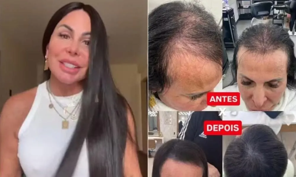 Gretchen mostra antes e depois surpreendente de seu cabelo após começar o tratamento contra a calvície; confira