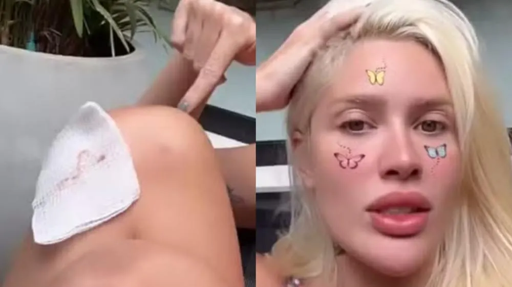 Karoline Lima sofre queimadura de segundo grau: 'Pior do que imaginava'
