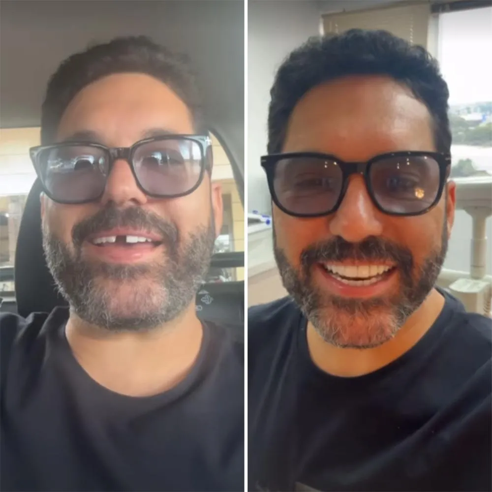 Edson, da dupla com Hudson, perde dente antes de show em Goiás