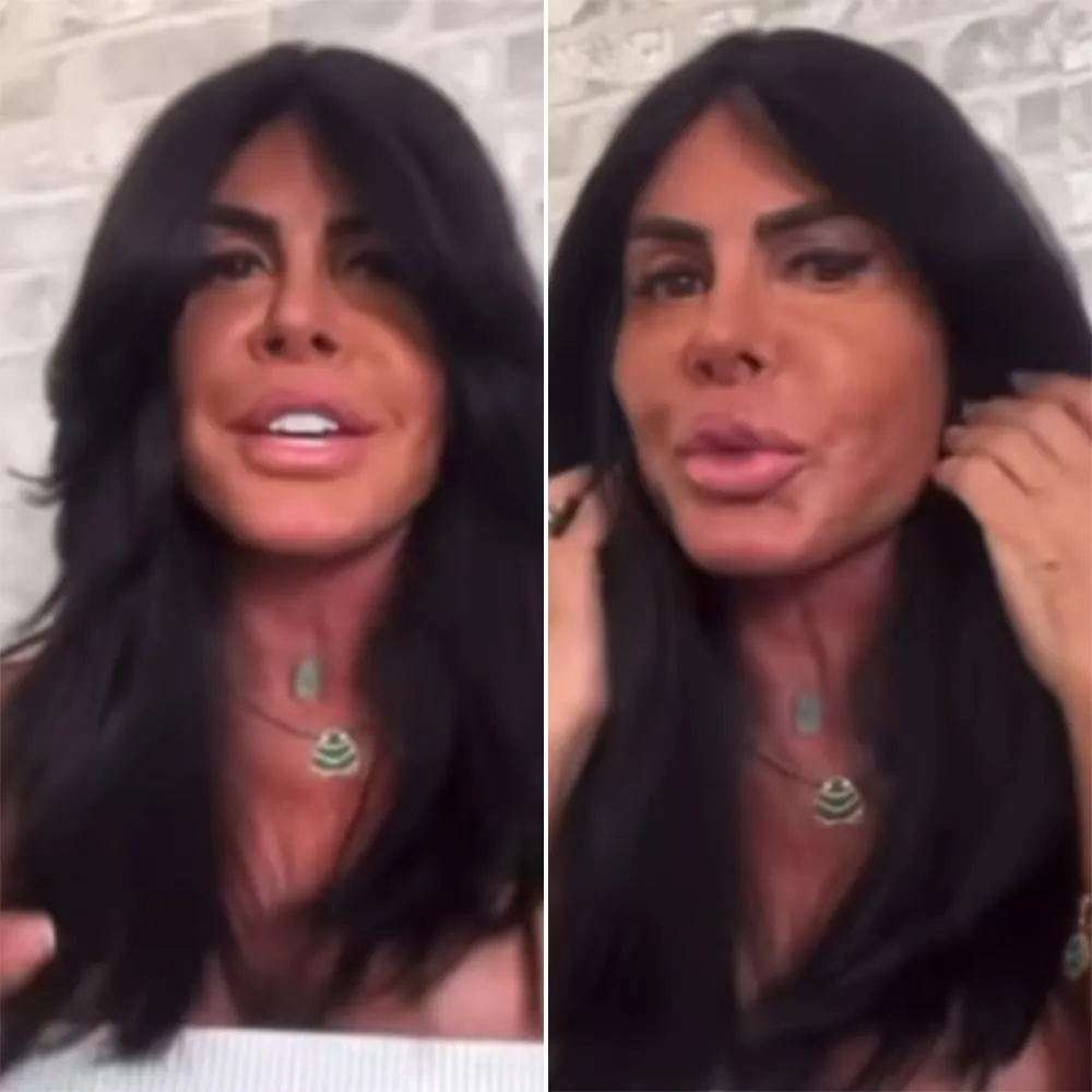 Cantora Gretchen exibe rosto sem filtro após início de novo protocolo estético