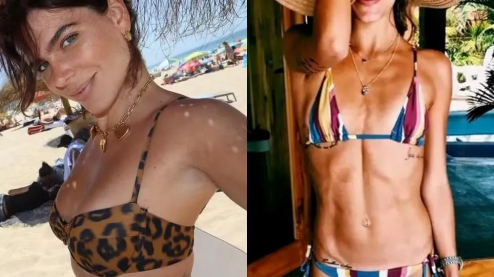 O relato de Mariana Goldfarb sobre seu diagnóstico de anorexia