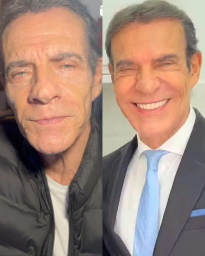Mário Gomes faz harmonização facial aos 72 anos; veja antes e depois