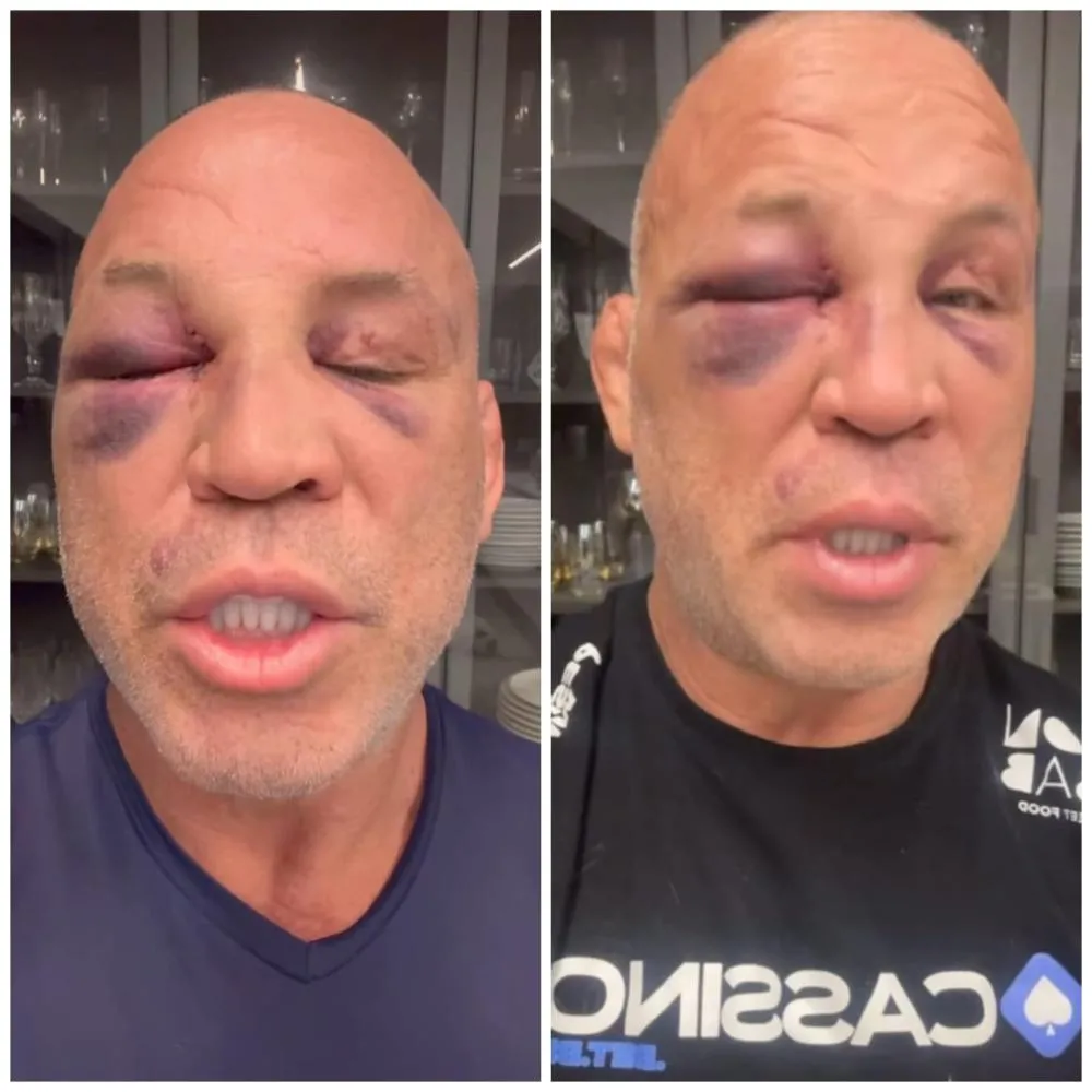 “A memória está voltando”: Wanderlei Silva revela detalhes da saúde após nocaute em confusão generalizada