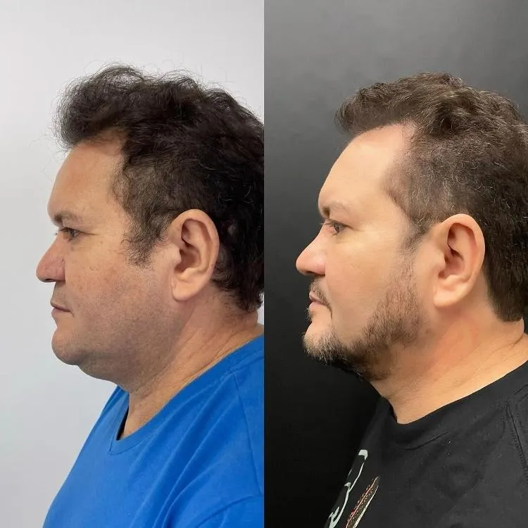 Ximbinha faz harmonização facial e exibe o resultado: veja o antes e depois