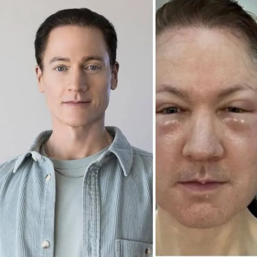 Bilionário famoso por fazer experimento humano com o próprio corpo para voltar a ter 18 anos, apresenta grave reação alergica a procedimento